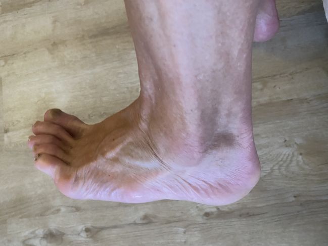 05/14/22 Arzua to Lavacolla: PG foot check
