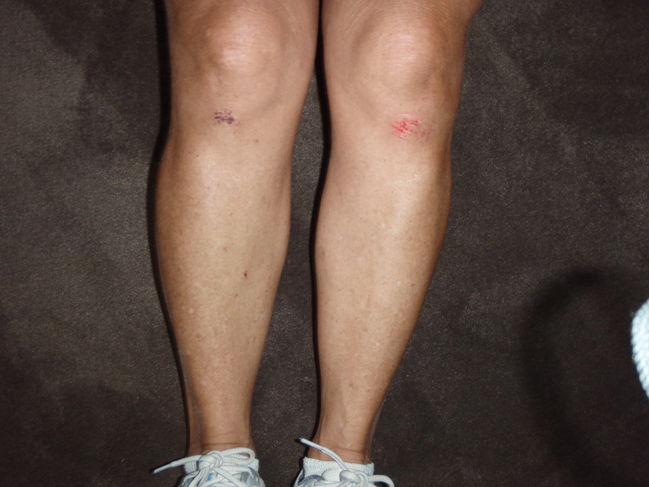 Helen's falls' wounds
